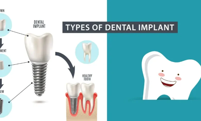 Types Of Dental Implants Available