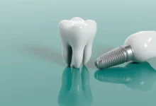 How Beneficial Are Dental Implants for a Confident Smile