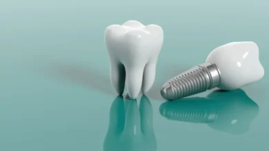 How Beneficial Are Dental Implants for a Confident Smile