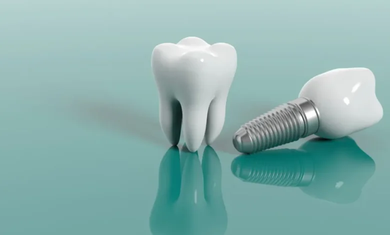 How Beneficial Are Dental Implants for a Confident Smile